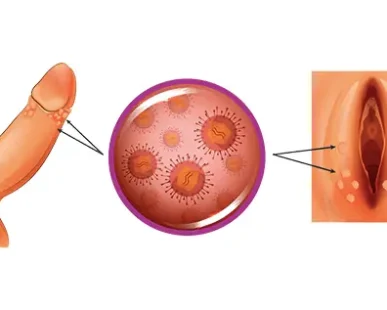 hpv-nedir