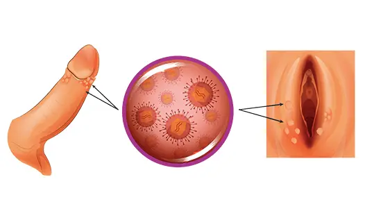 hpv-nedir